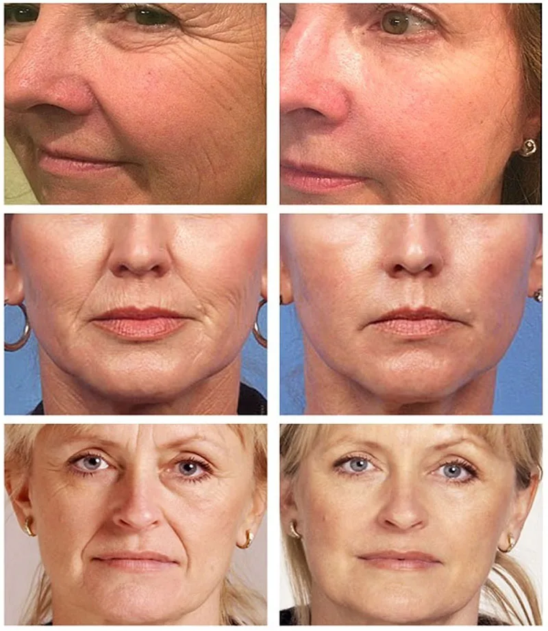 Collagen Wrinkle Remover Face  - Vitamin C Serum recension och pris